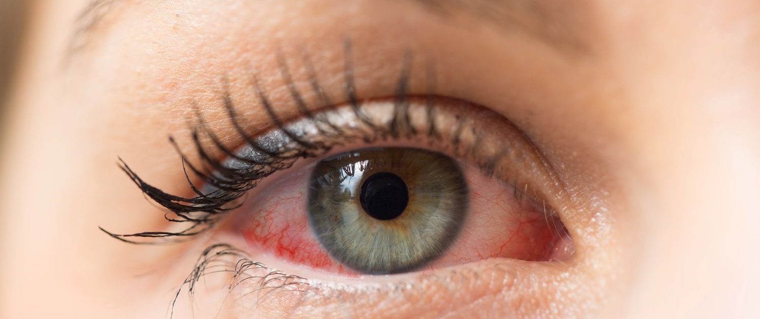 Allergik göz xəstəliklərinin sayı artıb